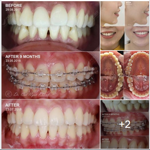  Ca lâm sàng: Niềng răng mắc cài sứ tự đóng (self-ligating) hoàn thành trong 11 tháng