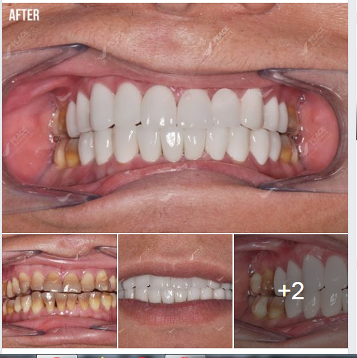Ca lâm sàng: Thẩm mỹ răng sứ cho răng nhiễm Tetracycline (Khách hàng đến từ Nhật Bản)