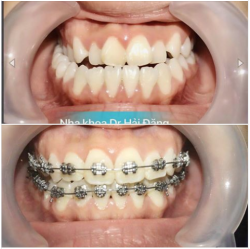 CẢNH BÁO VỀ NIỀNG RĂNG -TUỔI 30+ 