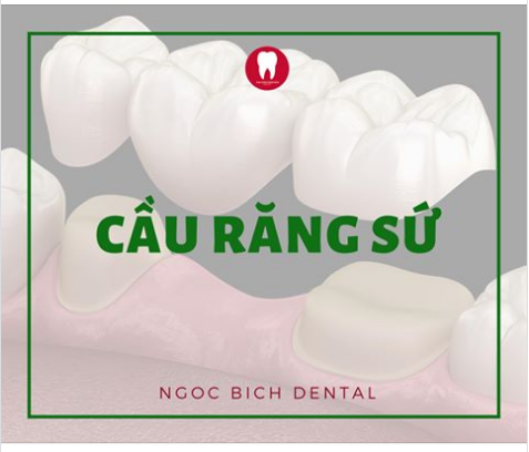 CẦU RĂNG SỨ - PHỤC HÌNH CÔNG NGHỆ CAO 