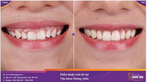 Cười hở lợi do thân răng ngắn, chiều cao của răng không cân xứng với chiều rộng thân răng dẫn đến sự không hài hoà giữa răng với lợi gây mất tự tin trong giao tiếp