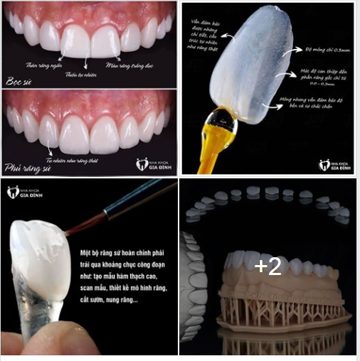 DÁN SỨ VENEER – THẨM MỸ RĂNG VÔ KHUẨN, AN TOÀN
