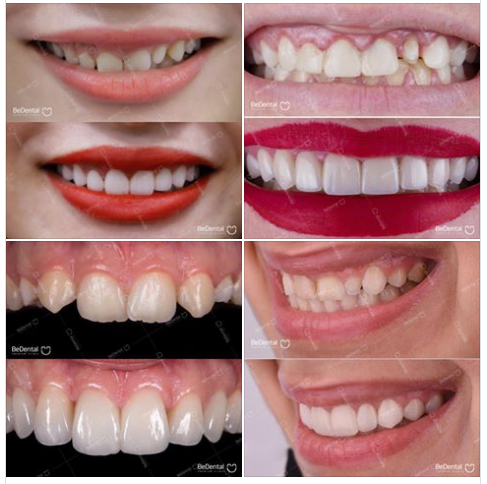 Bạn đã bao giờ cảm thấy tự ti vì hình thể răng xấu? Hãy tham khảo những hình ảnh được cập nhật mới nhất để biết thêm về các phương pháp khắc phục răng hình thể xấu và tự tin hơn trong cuộc sống.