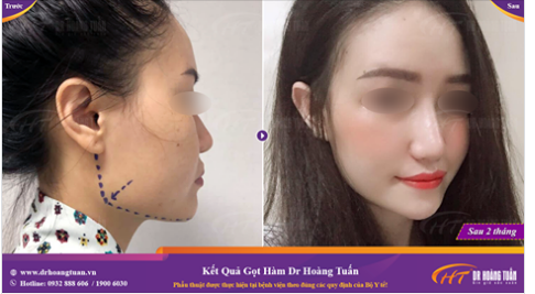 Nếu bạn đang lo lắng vì xương góc hàm to và bạnh khiến khuôn mặt mình trở nên thô và mất cân đối - hãy tham khảo phương pháp gọt hàm C-shape tại Dr Hoàng Tuấn!