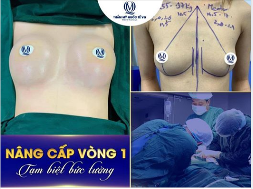  Ng ực hóa "cau khô" sau sinh khiến chị khách hàng phải nhờ tới Dr Vũ Quang để tân trang vòng 1 của mình.