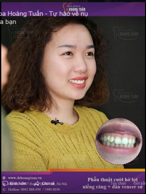 Nhờ COMBO dịch vụ niềng răng + phẫu thuật lật vạt xử lý cười hở lợi + dán sứ giúp chị ấy cười đẹp hơn, tự tin hơn.