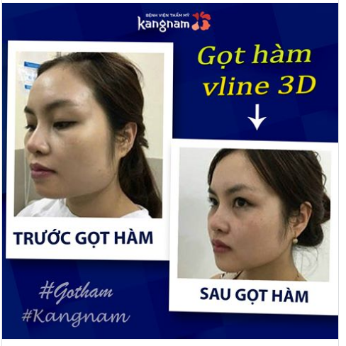 Nữ khách hàng thực hiện gọt hàm cho biết : “Trước đây chị vô cùng tự ti vì khuôn mặt vuông, hàm bạnh. Sau khi theo dõi chương trình Hành trình lột xác, chị đã lựa chọn gọt hàm ở BVTM Kangnam”.