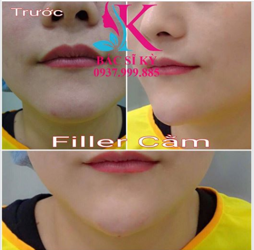 Tiêm Filler tạo cằm Vline đẹp sau 5 phút