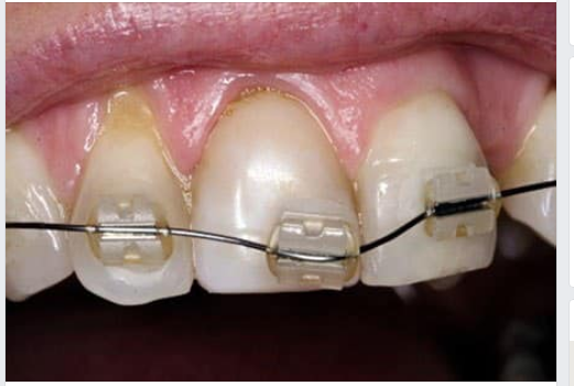 Tuột mắc cài (rớt mắc cài, bong mắc cài) là một trong những sự cố thường gặp nhất trong quá trình niềng răng mắc cài truyền thống.