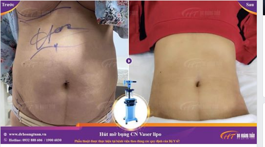 Vaser Lipo + J Plasma: Sự kết hợp tuyệt vời của 2 công nghệ hút mỡ hiện đại bậc nhất!