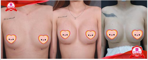 Xem ảnh thưc tế kết quả nâng ngực thế này có khiến các nàng háo hức đến gặp ê-kíp bác sĩ Bệnh viện Thẩm mỹ Hiệp Lợi không nè?