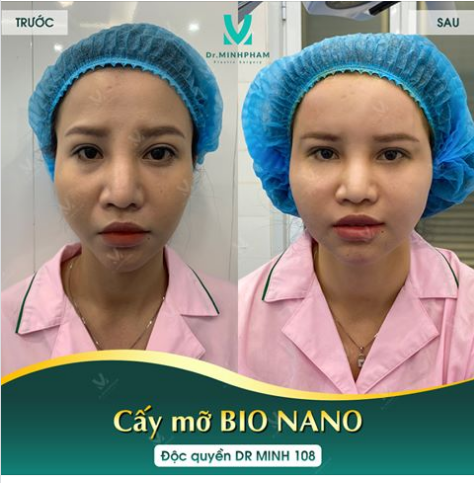Xem ngay kết quả ca livestream cấy mỡ Bio Nano của Dr Minh Phạm