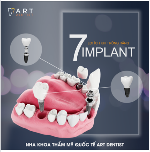 7 LỢI ÍCH khi trồng răng Implant
