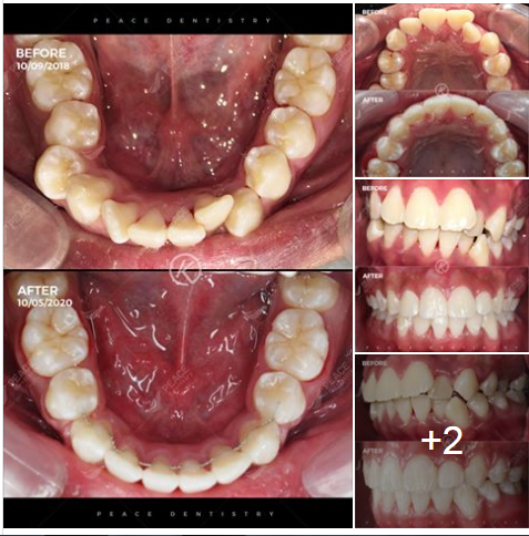Ca lâm sàng: Chỉnh nha cho trường hợp răng chen chúc, hô... trong 20 tháng (BS. Cao Ngọc Khánh – Peace Dentistry Quận 3)