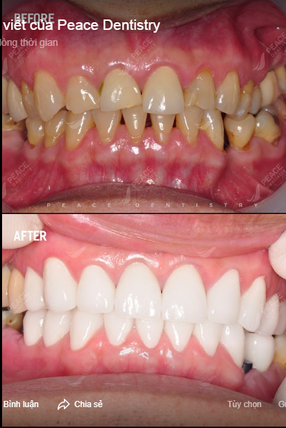 Ca lâm sàng: thẩm mỹ răng sứ nguyên hàm (Ceramill Zolid) và cấy ghép Implant (Hiossen – made in USA)