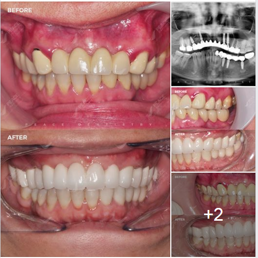 Ca lâm sàng: Thay thế cầu răng sứ bằng cấy ghép Implant (Hiossen – made in USA)