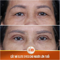 CẮT MÍ ELITE EYES CHO NGƯỜI LỚN TUỔI CÓ PHÙ HỢP KHÔNG?