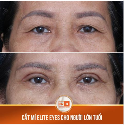 CẮT MÍ ELITE EYES CHO NGƯỜI LỚN TUỔI CÓ PHÙ HỢP KHÔNG?