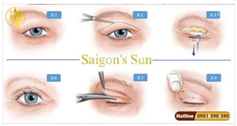 Cứu Mắt 1 Mí, Mí Lót -  MẤT TỰ TIN