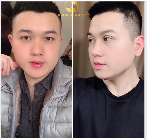 KHUÔN MẶT CHUẨN “SOÁI CA” NHỜ 15’ CẮT MÍ