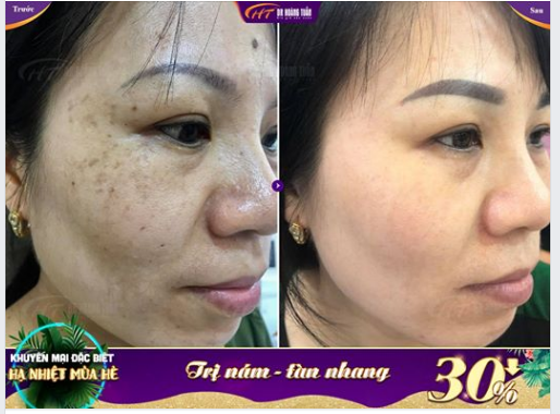Một kết quả trị nám tuyệt vời tại Dr Hoàng Tuấn! Da đẹp hơn - Trẻ hơn