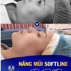 NÂNG MŨI SOFTLINE - MŨI ĐẸP CHUẨN NHÂN TRẮC HỌC CHỈ SAU 30 PHÚT