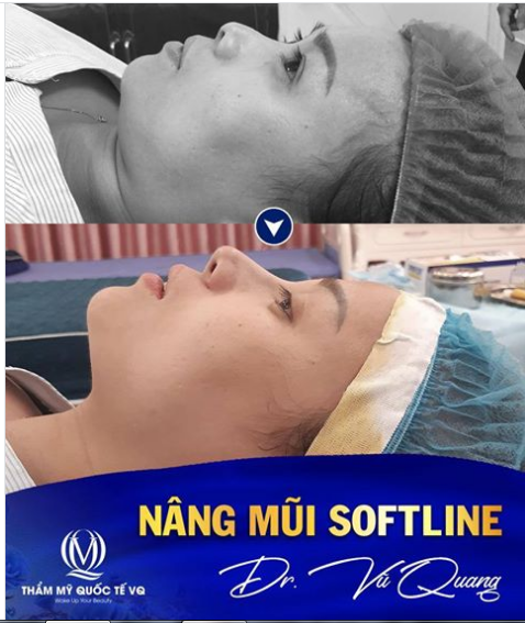 NÂNG MŨI SOFTLINE - MŨI ĐẸP CHUẨN NHÂN TRẮC HỌC CHỈ SAU 30 PHÚT
