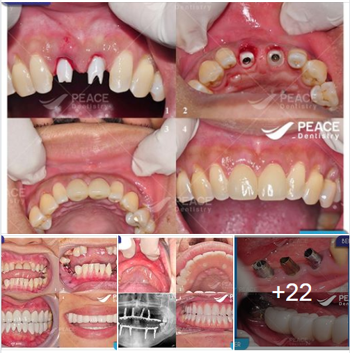 Trồng răng Implant: Before - After