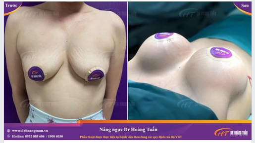 Với tình trạng ngực sa trễ độ 2, tuyến vú teo, nâng ngực kết hợp treo sa trễ theo đường quầng vú là phương án tối ưu để cải thiện vòng 1.