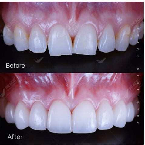 Ca lâm sàng: Dán 8 mặt sứ Veneer Emax, chọn tone màu theo răng thật