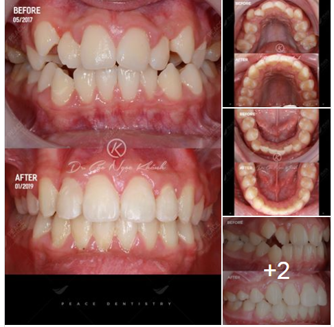 Ca lâm sàng: Niềng răng mắc cài tự buộc (self ligating) khắc phục răng mọc chen chúc nhiều, sai khớp cắn hạng 1, kết hợp nong 2 hàm… tháo niềng sau 20 tháng.