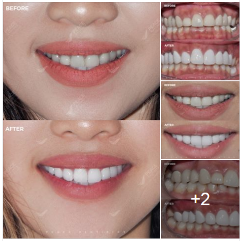 Ca lâm sàng: Thay răng sứ cũ, bọc lại răng sứ mới hàm trên giúp lột xác toàn diện nụ cười (Sứ 3M Lava Plus – made in USA)