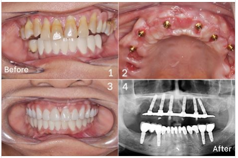 Ca lâm sàng: Trồng răng Implant toàn hàm All-on-6 (HT) 4 trụ Implant (HD)