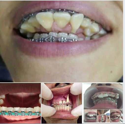 Dưới đây là hình ảnh của những ca niềng răng bị hỏng, bị lỗi do khách hàng lựa chọn các cơ sở Nha khoa không đảm bảo uy tín