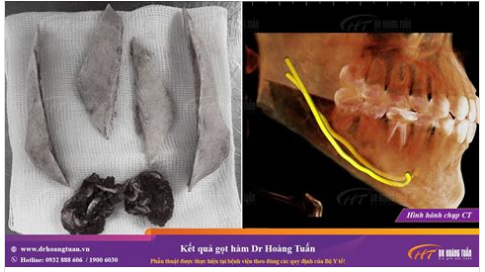 Gọt hàm là một nghệ thuật, và người gọt hàm là một nghệ sĩ - mời cả nhà đến với nghệ thuật cắt xương góc hàm Dr Hoàng Tuấn!