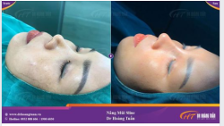 Kết quả ngay sau khi sử dụng dịch vụ nâng mũi Sline tại Dr Hoàng Tuấn!