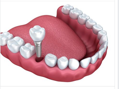 Khi nào thì nên đặt Implant  Khi nào thì nên làm cầu răng