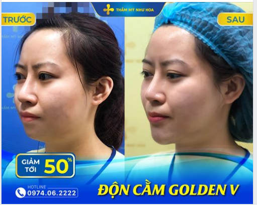 Khuyết điểm gương mặt nằm ở chiếc cằm ngắn lẹm, khách hàng chọn Độn cằm Golden V và sự khác biệt xuất sắc chỉ sau 30 phút thực hiện.