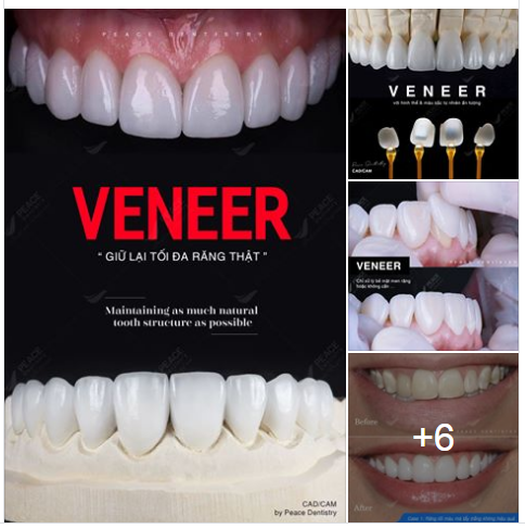 Mặt dán sứ Veneer – Giữ lại tối đa răng thật