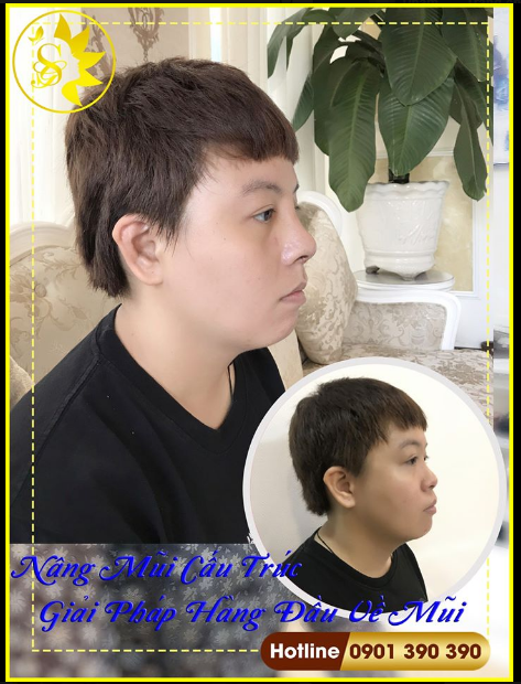 MŨI SAU 7 NGÀY CẮT CHỈ SẼ NHƯ THẾ NÀO?