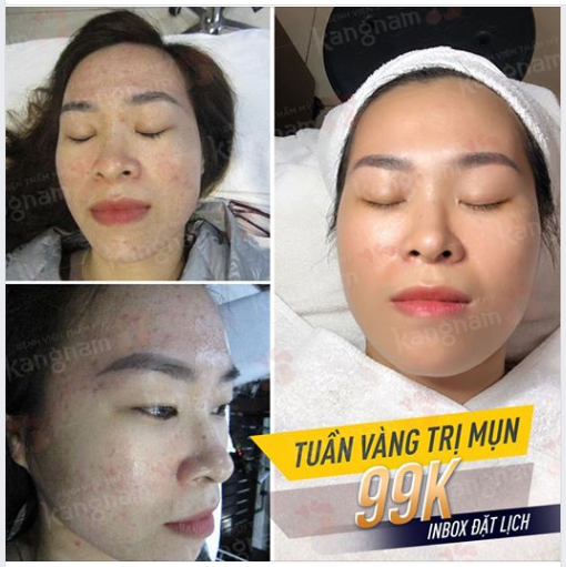  Phác đồ điều trị mụn Nano Skin tại Kangnam của 1 KH