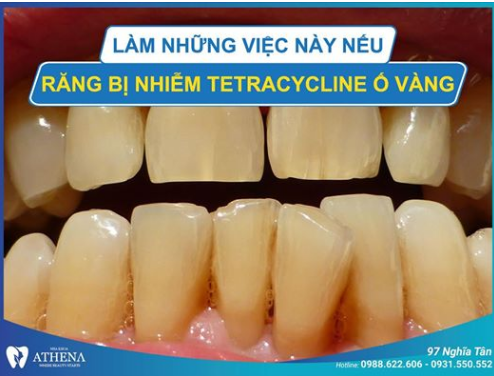 Răng ố vàng do Tetracycline Quá đơn giản- Đọc ngay bài dưới đây để khắc phục.
