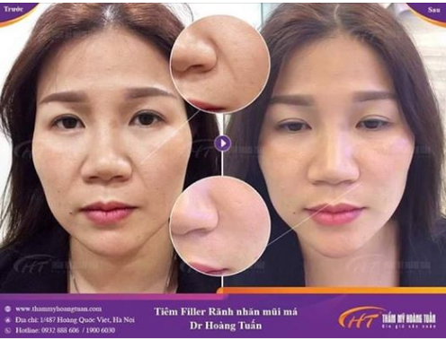 Tìm lại sự trẻ trung chỉ với 1ml Filler xóa nhăn rãnh mũi má Dr Hoàng Tuấn