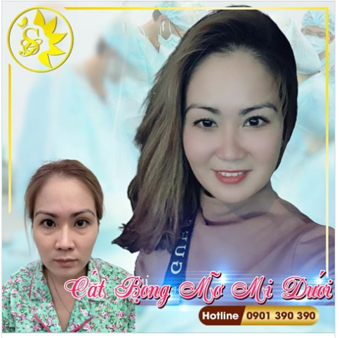 TRẺ HOÁ ĐÔI MẮT Cắt Bọng Mỡ Mi Mắt Dưới Sau 3 Tháng