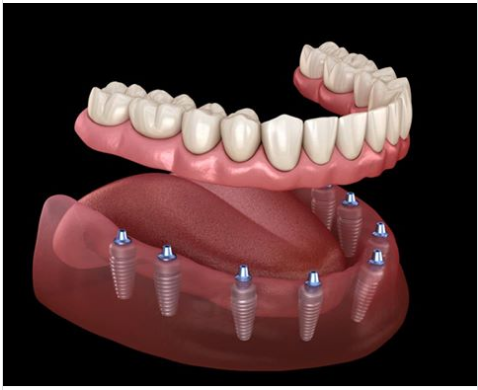 Trồng răng bằng Implant như thế nào khi mất răng toàn hàm