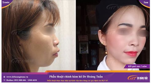 Trước và sau phẫu thuật chỉnh hàm hô 1 năm tại Dr Hoàng Tuấn - đã khác chưa cả nhà?