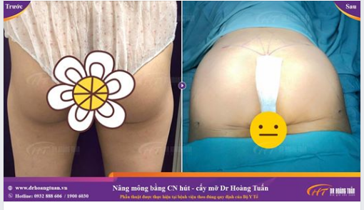Với đặc điểm giải phẫu người Châu Á, vòng 3 thường kém nảy nở. Đặc biệt là mặt ngoài mông.