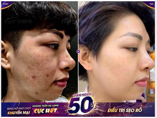 Xuất sắc! Kết quả trị sẹo rỗ cho bạn gái sau 4 buổi với công nghệ UltraPulse tại Dr Hoàng Tuấn