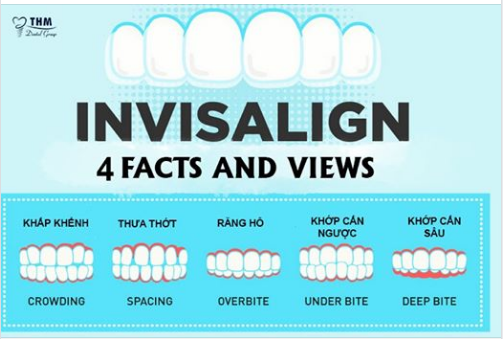  4 FACTS VIEWS OF INVISALIGN