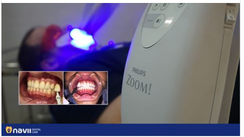 Bí quyết giúp răng trắng sáng đến từ Zoom WhiteSpeed tại Navii Dental Care 